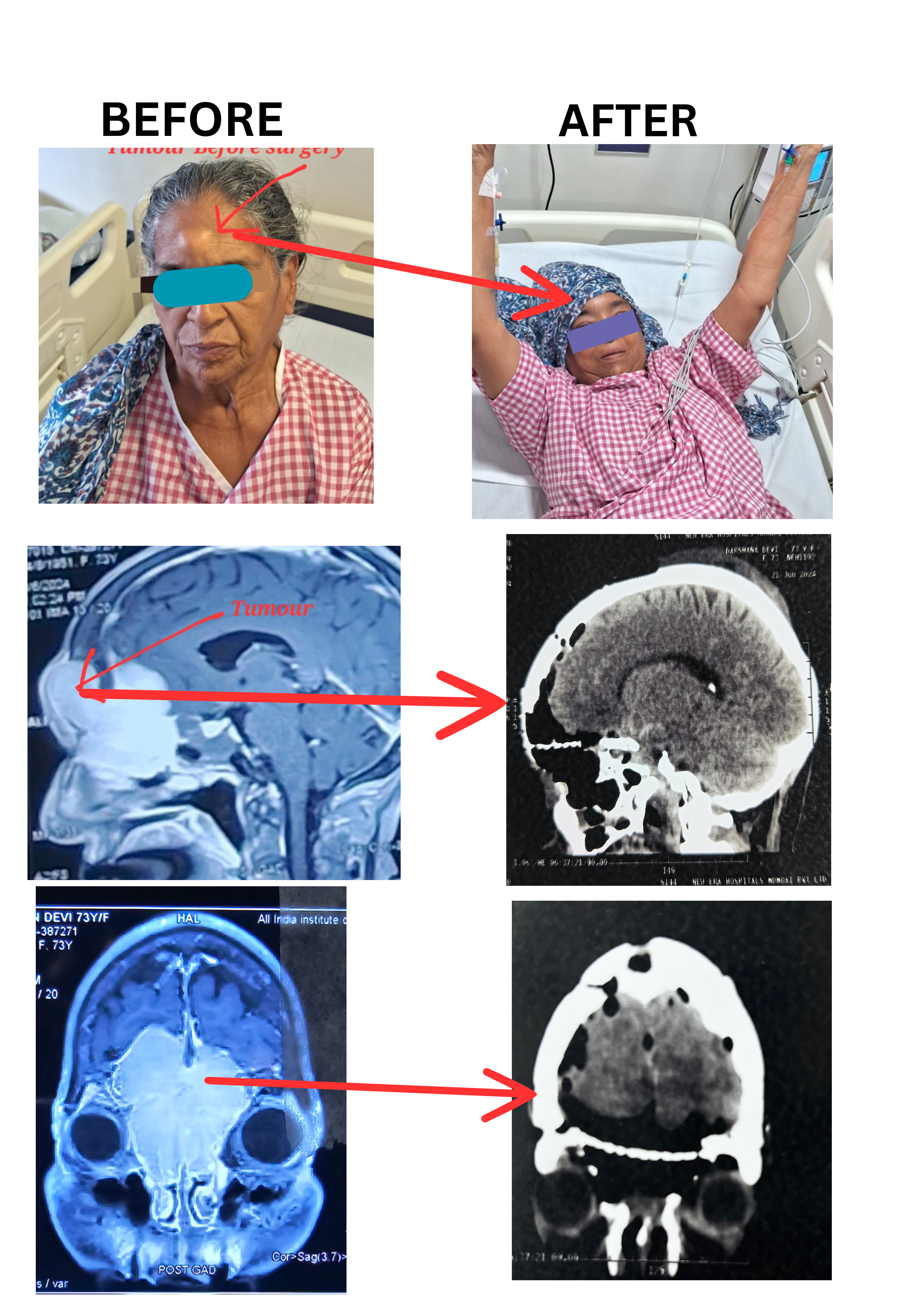 Successful Treatment of Complex Skull Base Tumor at NewEra Hospital